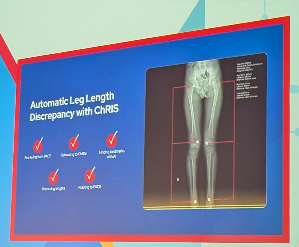Keynote slide titled Automatic Leg Length Discrepancy with ChRIS, with five checked steps next to a full-leg X-ray with measurement lines